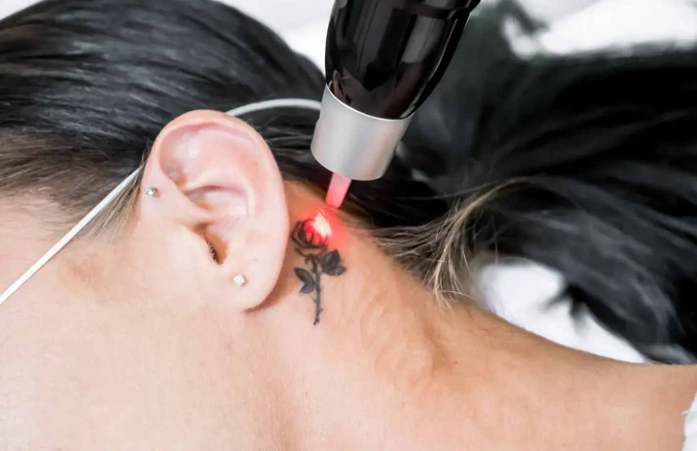 tratamiento laser para eliminar manchas en piel y tatuajes